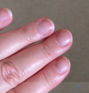 Vicki's nails before treatment began