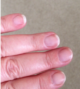 Vicki's nails looking better after treatment for 6 days